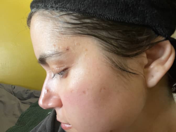 After image of using Pai Rosehip Oil
