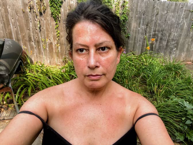 Photo of woman with redness from the sun